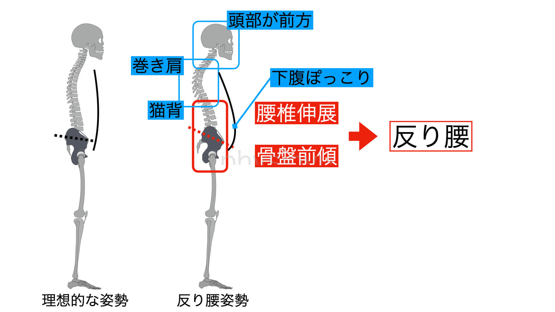 かんたん反り腰の治し方 原因と解決方法 ユウスケ 筋トレ怪我ゼロプロジェクト Blog