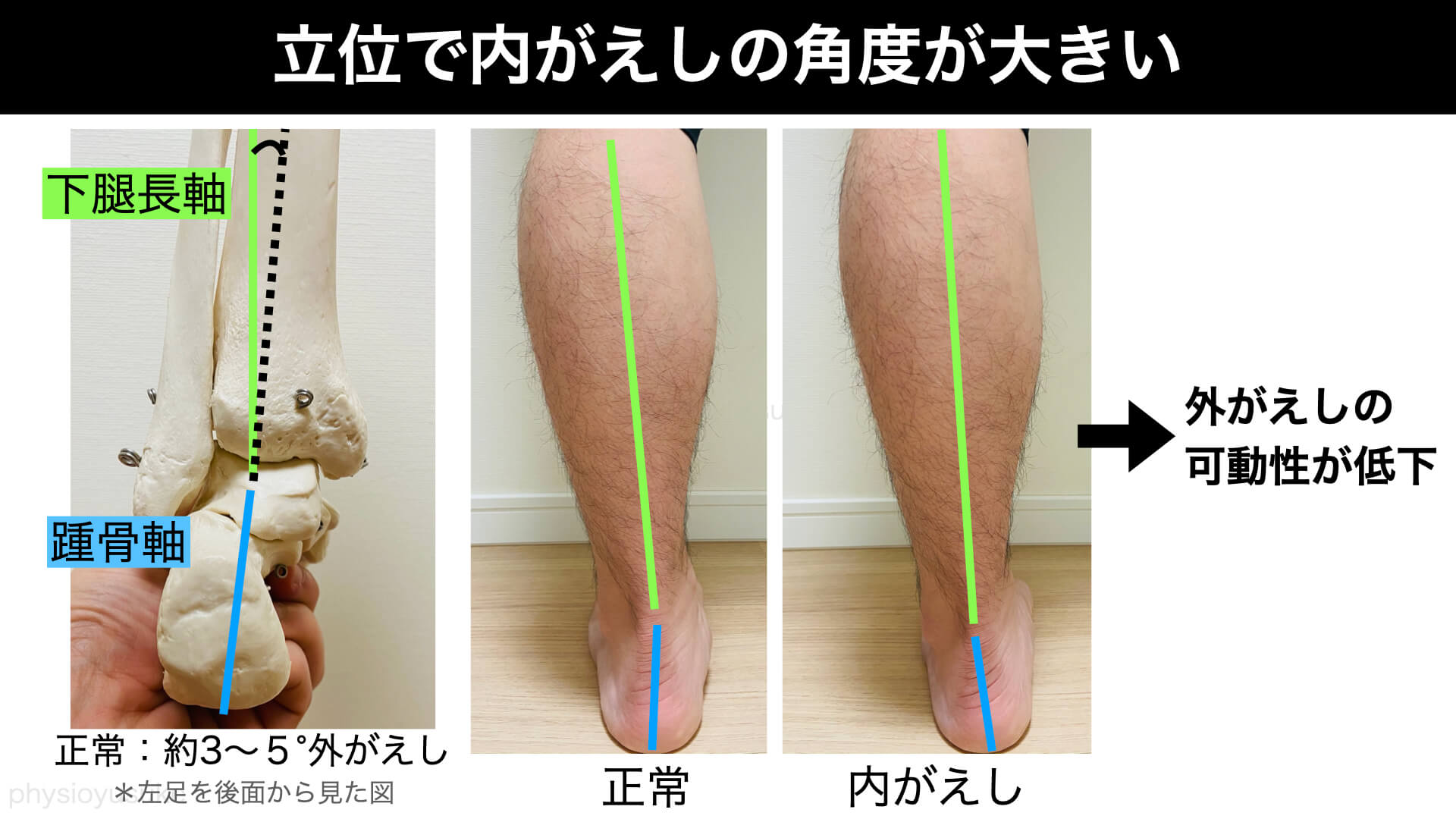 どのようにしてスクワットの ニーイン を解消するか 膝の痛みの原因と対処法 ユウスケ 筋トレ怪我ゼロプロジェクト Blog